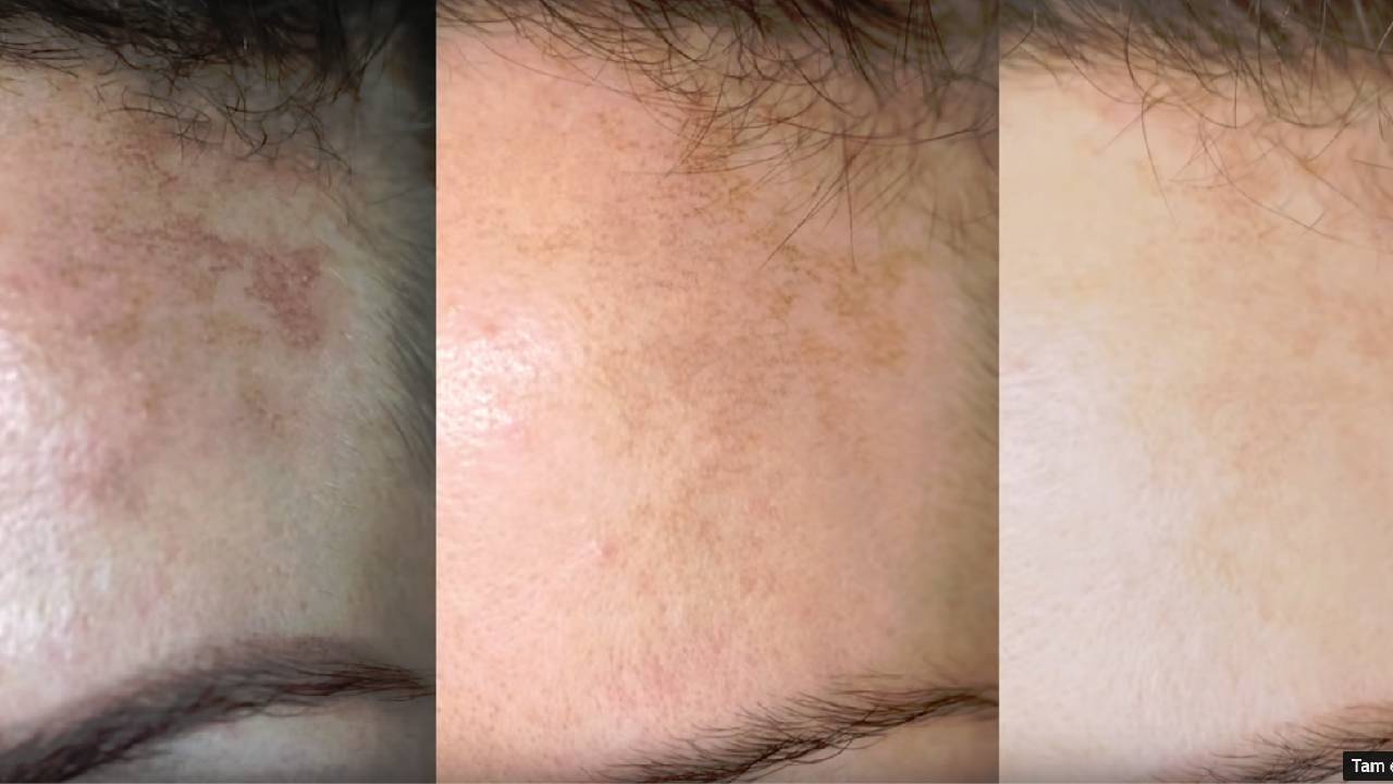 Başımızın belası güneş lekelerine karşı patlıcan mucizesi