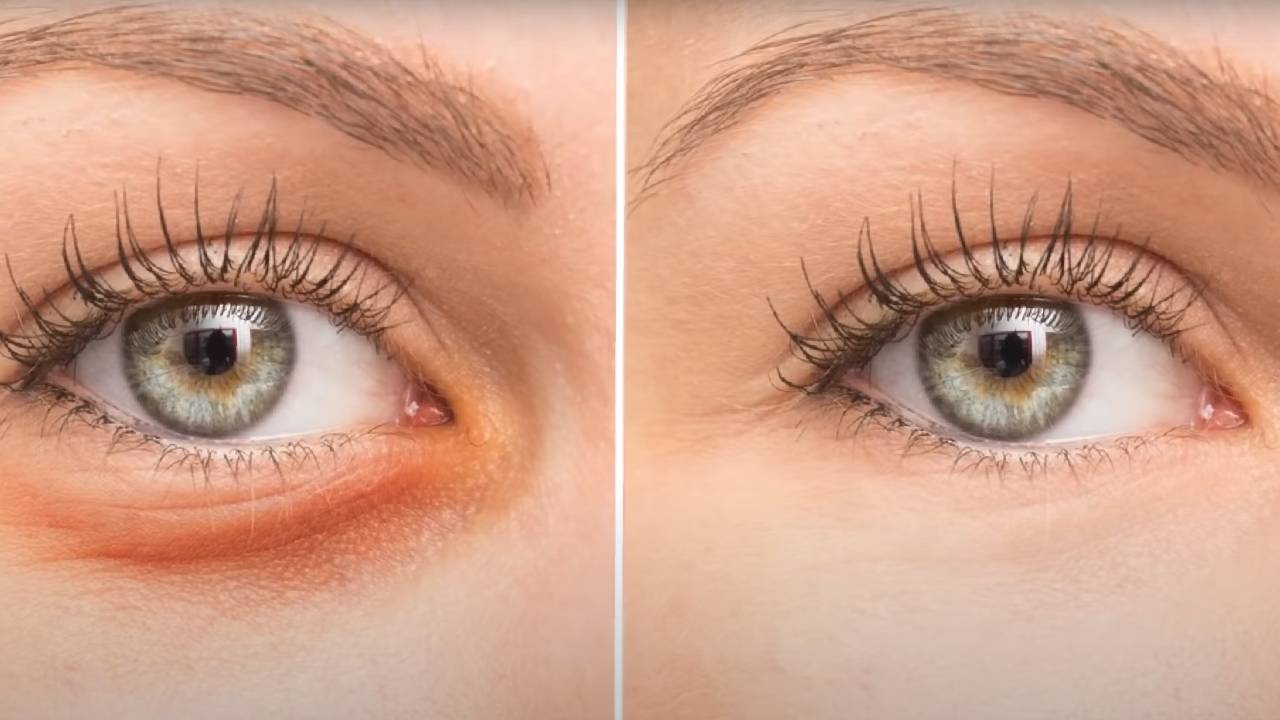 Göz altı torbalarından kurtulmanın 3 etkili yolu