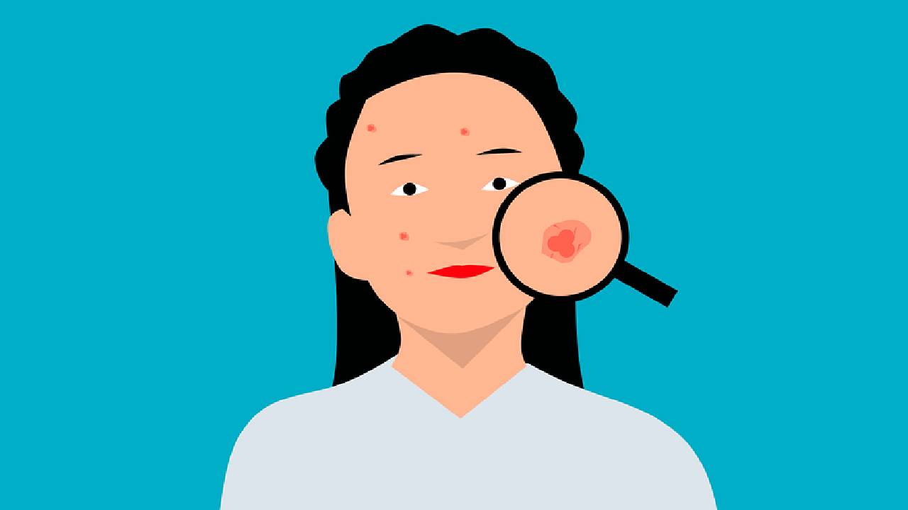 Uzmandan sivilce izlerini yok eden gizli förmül