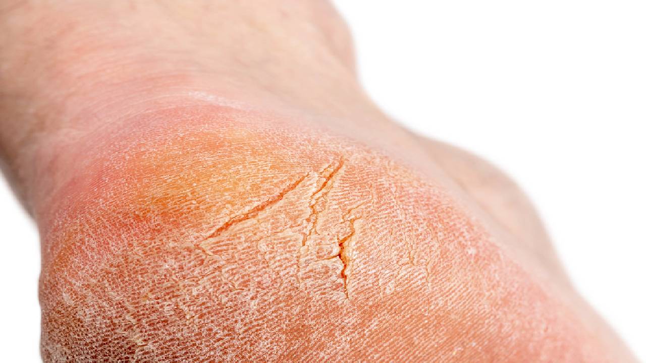 Topuktaki çatlaklar neden olur? Topuk çatlağı için ne yapılır?