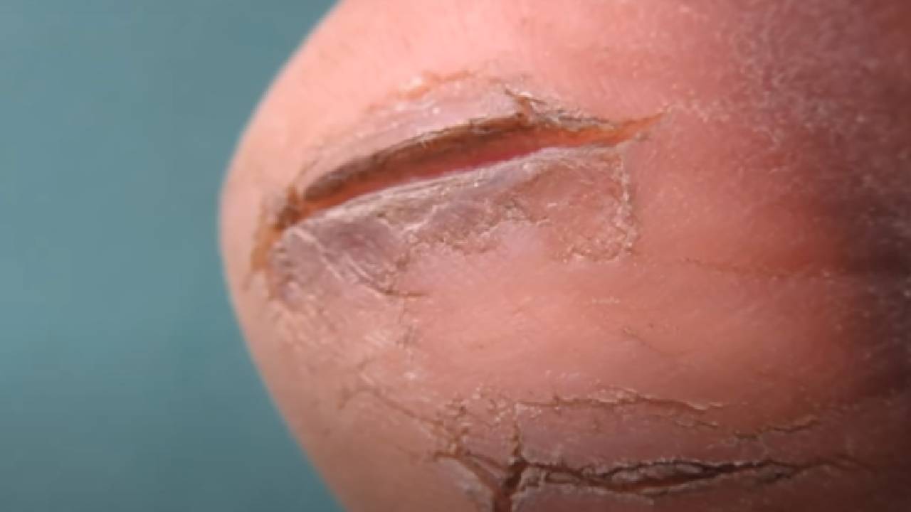 Topuk çatlakları hangi vitamin eksikliğinden olur?