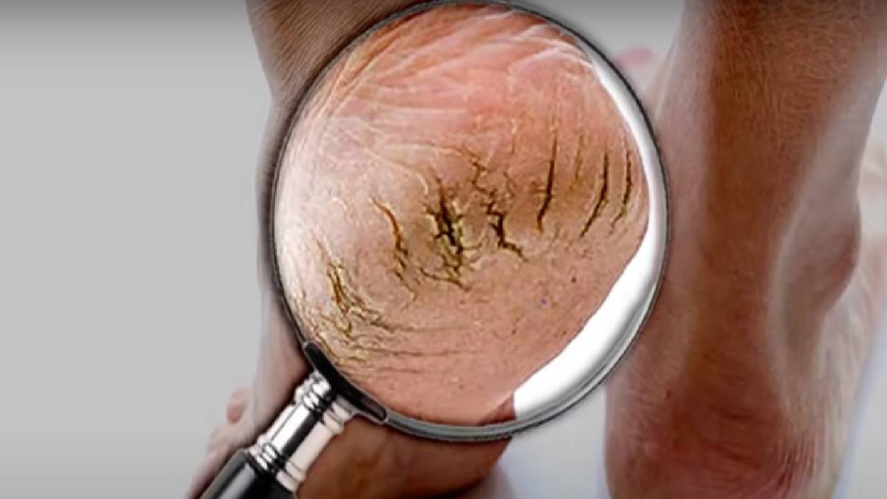 Topuk çatlağı hangi hastalığın belirtisidir?