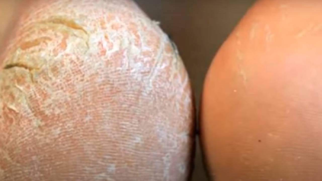 Topuk çatlaklarına ne iyi gelir? Çatlamış topuklar için ne yapmalı?