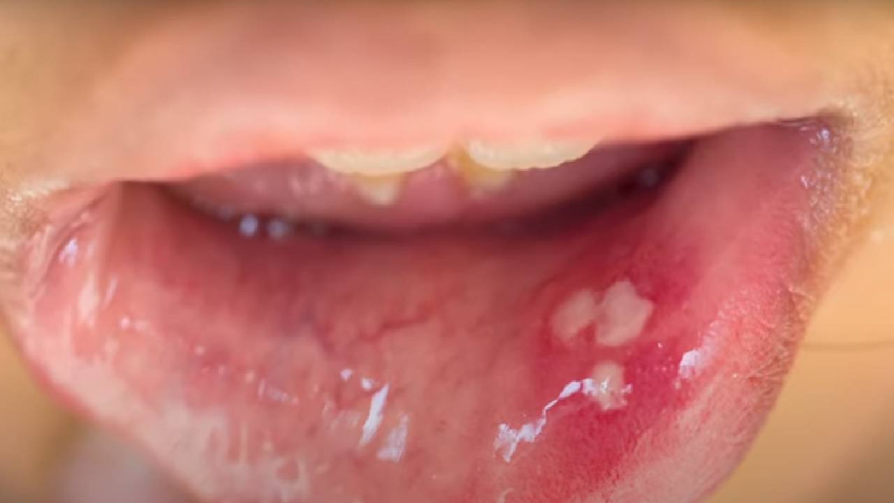 Aft nedir? Aft nasıl geçer? Ağız yarasına ne iyi gelir?