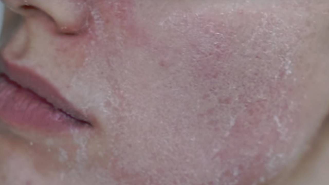 Kış aylarında en çok görülen 4 cilt hastalığı