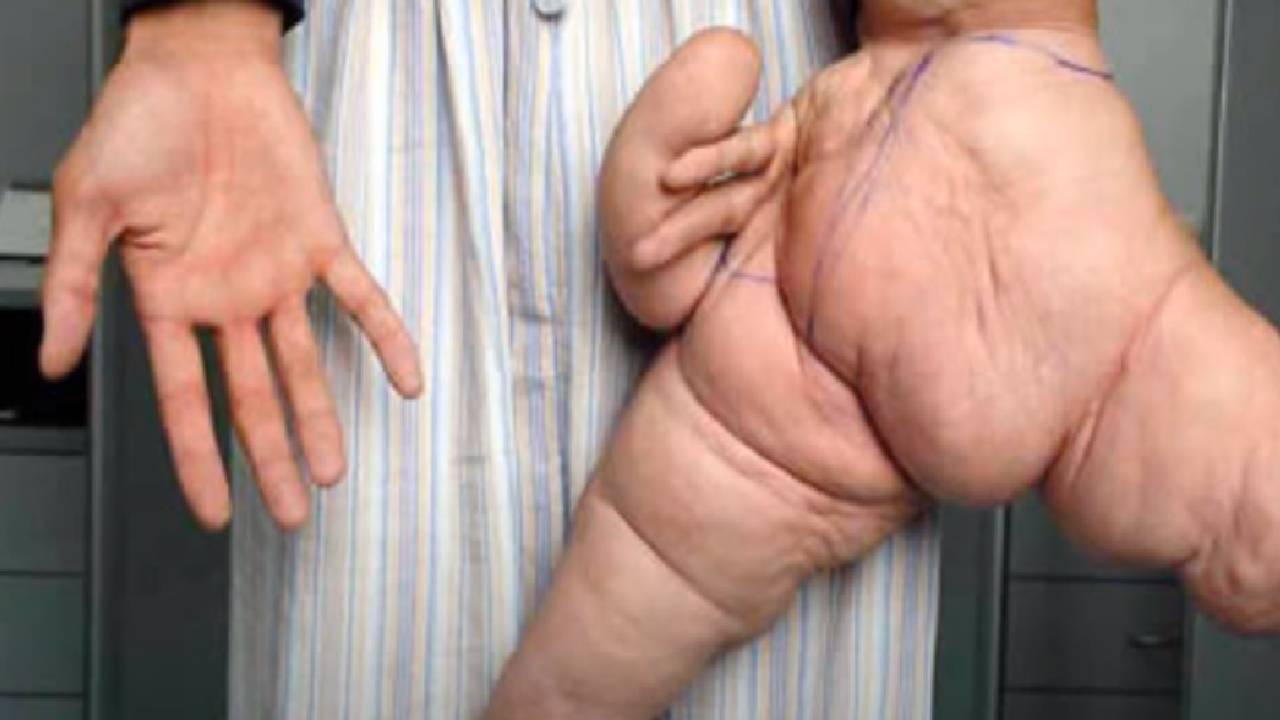 Akromegali hastalığı nedir? Akromegali neden Olur?