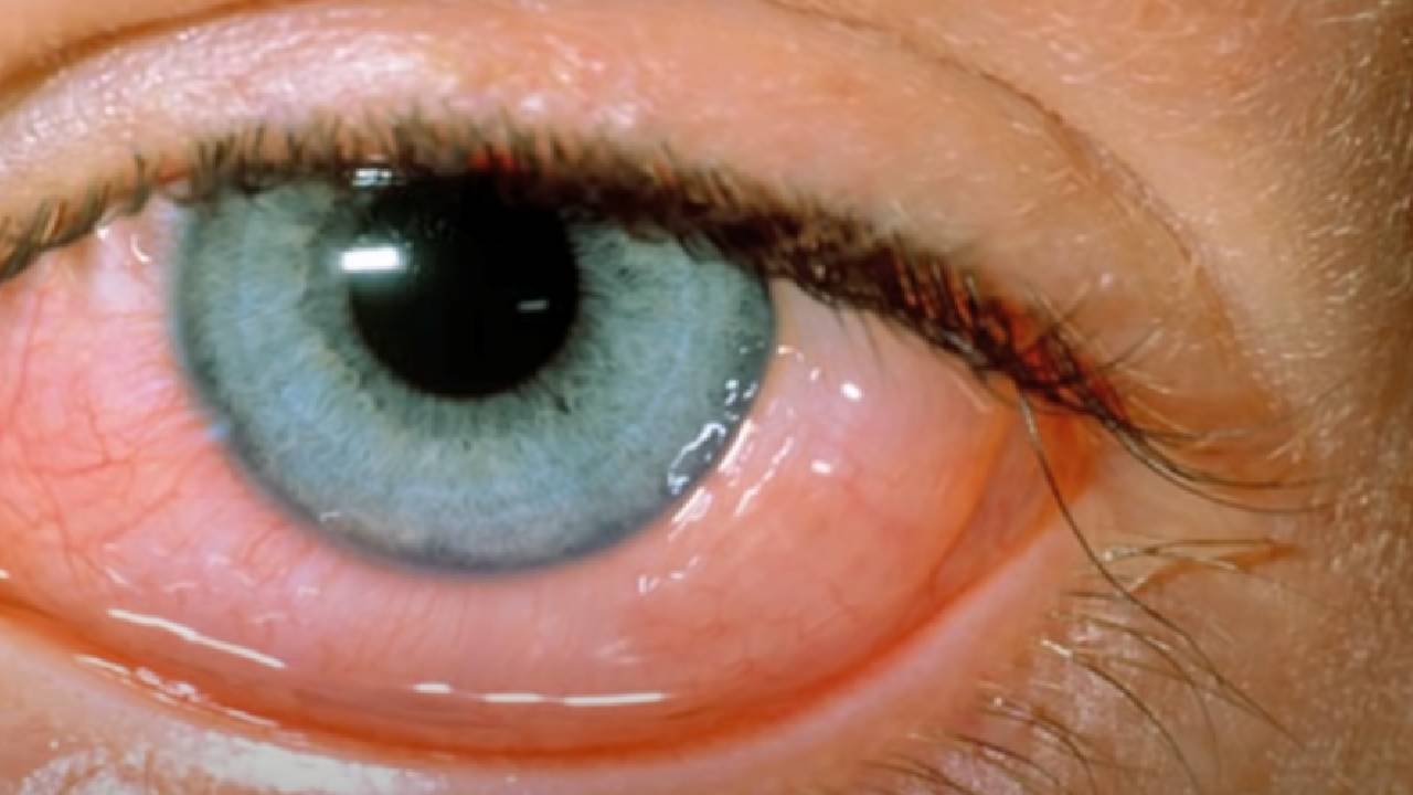 Göz enfeksiyonuna ne iyi gelir? Göz iltihabına iyi gelen besinler