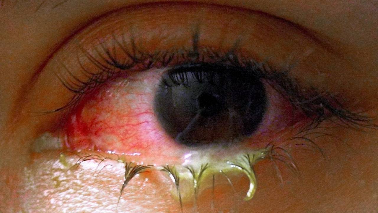 Konjonktivit nedir? Konjonktivit belirtileri nelerdir, nasıl tedavi edilir?