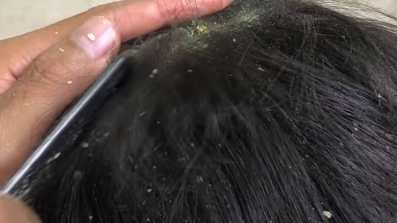 Kışın kepekten hemen kurtulmanın 5 doğal yolu