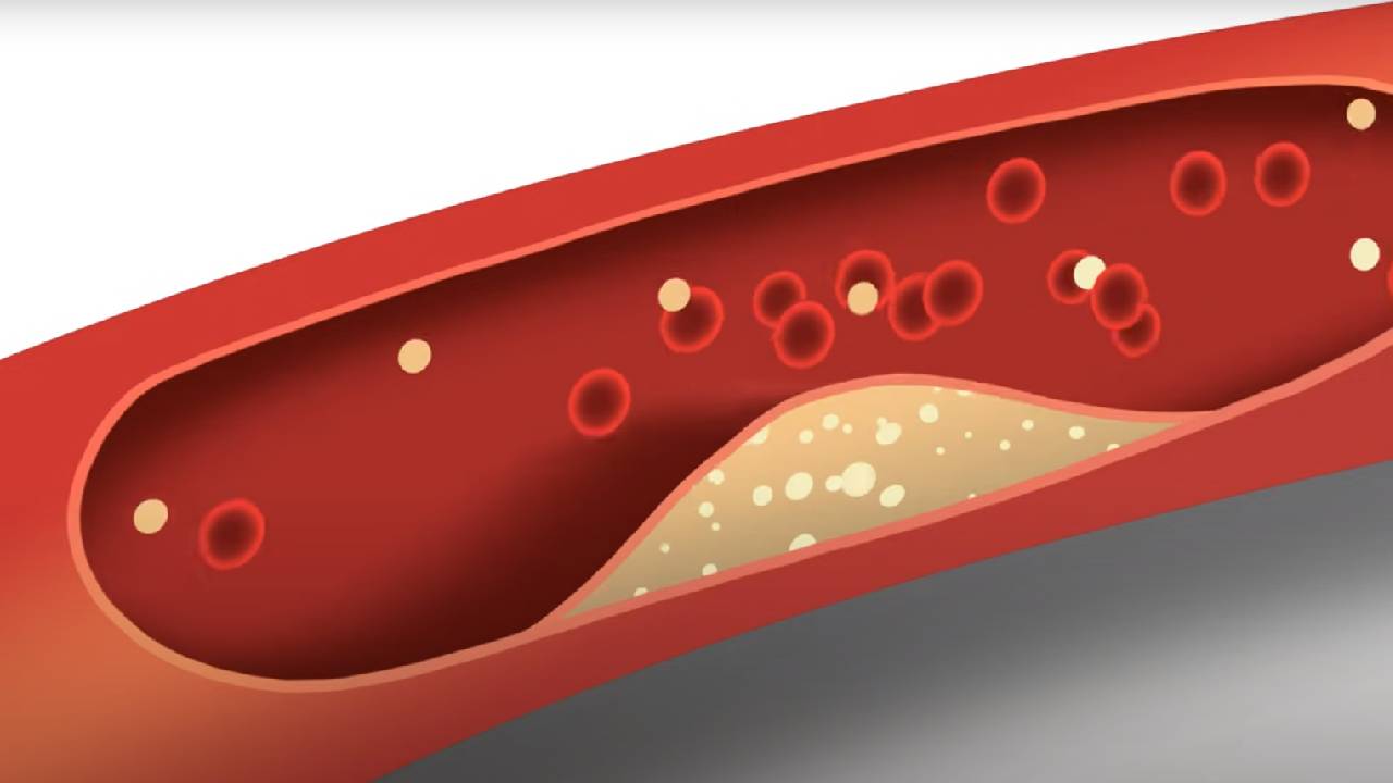 Kolesterol neden yükselir? Kolesterol yüksekliğinde ne yapmak gerekir?