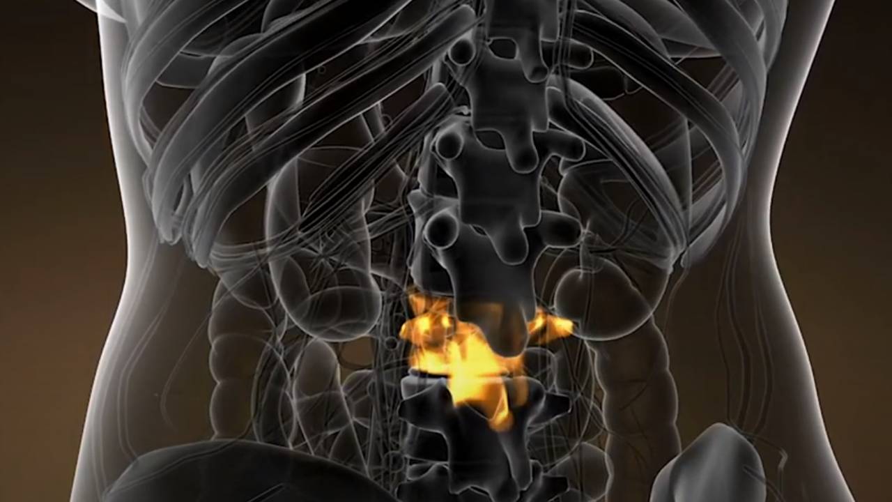 Bel fıtığı belirtileri nelerdir? Bel fıtığı teşhisi nasıl koyulur?