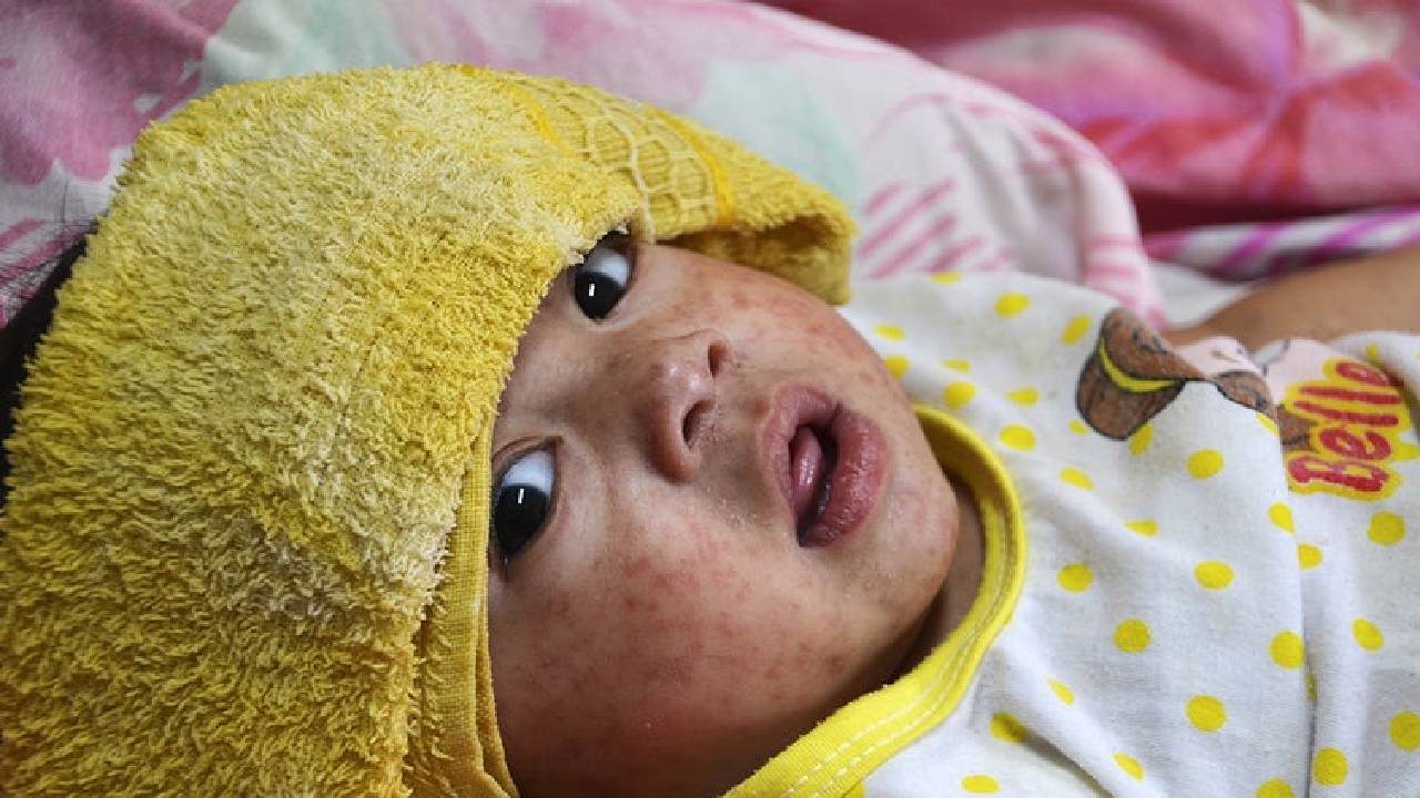 Kızamık nedir? Kızamık nasıl belirti verir? Nasıl bulaşır?