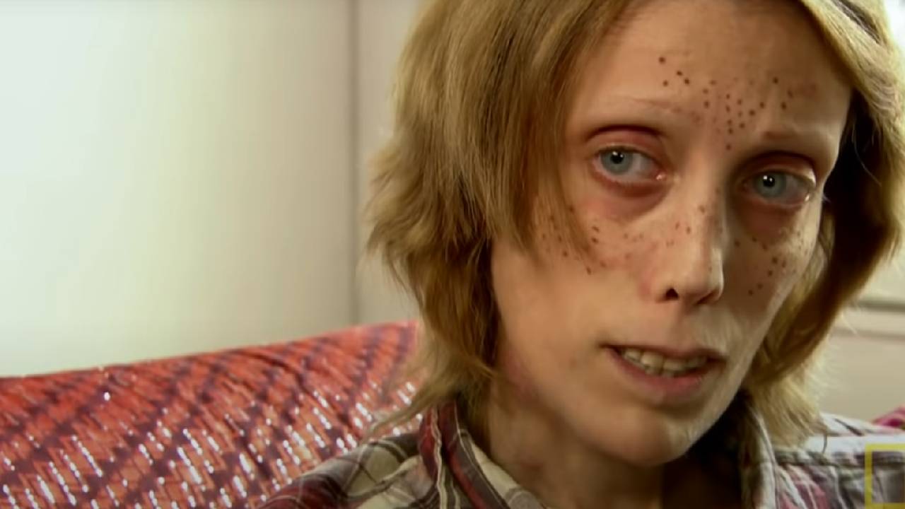 Yeme bozukluğu nedir?  Anoreksiya nervoza nasıl tedavi edilir?